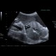 Liver cirrhosis, macronodular, ascites, massive: US - Ultrasound